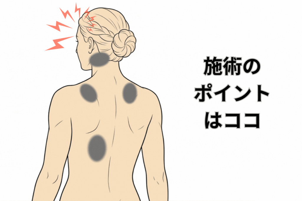 頭痛の施術ポイント
